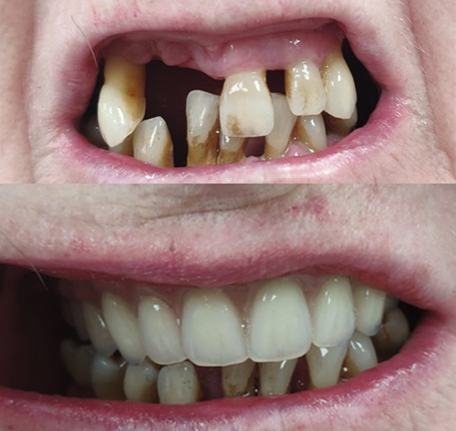Dr Nikolis smile in a day before and after 